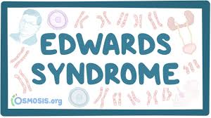 This is a fatal disorder which interferes before and after birth. Edwards Syndrome Trisomy 18 Osmosis