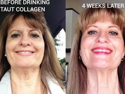 Turkey Neck Best Treatments And 5 Tips To Tighten Neck Skin Turkey Neck Tighten Neck Skin Improve Skin Elasticity
