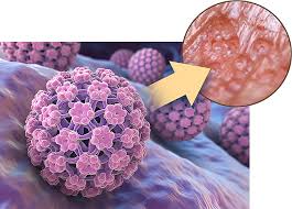 Image result for human papillomavirus symptoms