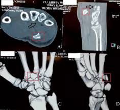 Image result for Hamate Bone