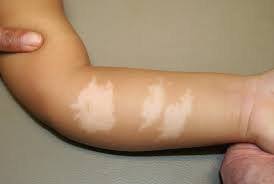 Natural Vitiligo Treatment White Spots On Arms