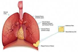 I Beat Mesothelioma Mesothelioma Cancer Diagnosis Mesothelioma Cancer