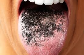 Image result for black hairy tongue symptoms