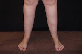 See full list on wikihow.com Lipoedema Nhs