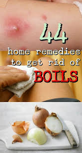 Homeremedyhacks Home Remedy For Boils Get Rid Of Boils Health Remedies