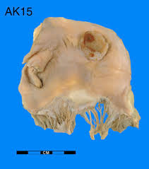 We did not find results for: Mural Thrombus In Left Atrium Museum Of Pathology