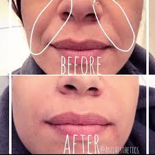 Fillers can be charged by units or by area, he says. Before And After Dermal Fillers To Get Rid Of Smile Lines Agingskincaretipslookingyounger Facial Fillers Dermal Fillers Derma Fillers