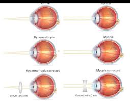 Image result for Refractive Error
