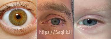 Miyozis Nedir Nedenleri Belirtileri Ve Miyozis Tedavisi Saglik Li