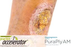 Image result for Wound