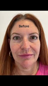 Two filler Restylane Lyft Restylane Kysse I treated her under eyes wit...