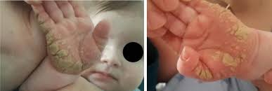 Image result for scabies norvegica