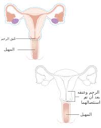 استئصال الرحم ويكيبيديا
