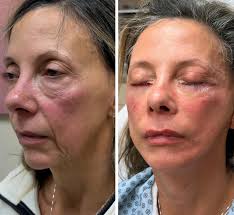 Another miracle day!!!!🔥❤️🔥Lower eyelids and the Hourlift.  #minifacelifting #minifaceliftsandiego #minifaceliftbeforeandafter  #blepharoplasty #facelift hourlift hourliftbydrseiger faceliftmichigan  faceliftbeforeandafter cosmeticsurgery ...