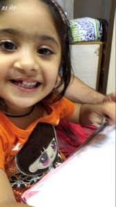 Cleft lip Boy 2 Years after Surgery