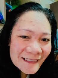 Warning about monkeypox cases in the region