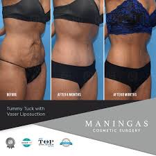 Results From Tummy Tuck Surgery With Intense Core Liposuction And Ab Etching With Ultrasound Assist Aka Vaser Lipos Tummy Tucks Tummy Tuck Surgery Liposuction