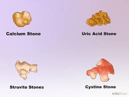 Apabila kencing pekat, kompaun di dalam air kencing boleh mendekati satu sama lain dan membentuk. Cara Merawat Batu Karang Hingga Sembuh Ladywankaydiary Com