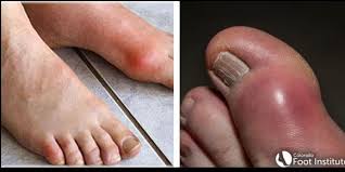 Image result for gout symptoms toe