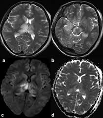 Herpes simplex (hsv) encephalitis is the most common cause of fatal sporadic fulminant necrotizing viral encephalitis and has characteristic imaging findings. Imaging Of Central Nervous System Viral Diseases Gupta 2012 Journal Of Magnetic Resonance Imaging Wiley Online Library