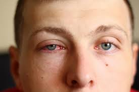 Check spelling or type a new query. Eye Drops For Itchy Eyes Options And When To Use Them