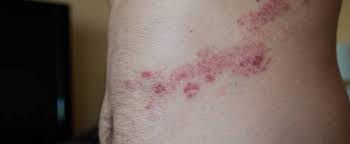 Woman contracted the deadly respiratory disease while cleaning abandoned home infested with rodents. Hantavirus Hautausschlag Hantavirus Ausschlag