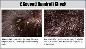 I'm not sure what's happening with my scratch. Alpecin What Causes Dandruff