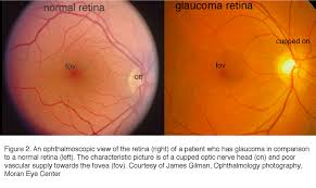Glaucoma is an optic neuropathy leading to changes in the intrapaillary and parapaillary regions of the optic disk. What Is Glaucoma By David Krizaj Webvision