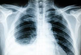 Trauma thorax adalah semua ruda paksa pada thorax dan dinding thorax, baik trauma atau ruda 2. Pneumothorax Gejala Penyebab Dan Pengobatan Hello Sehat