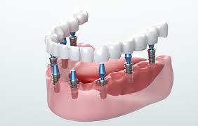Dental implants: A 5-step plan to restore your teeth | Aging | Discovery |  UT Southwestern Medical Center