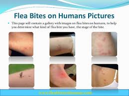 Image result for scabies bite