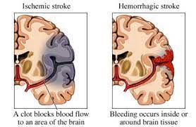 A stroke, or brain attack, occurs when blood circulation to the brain fails. Acute Stroke Brain Attack Ucla Interventional Neuroradiology Los Angeles Ca