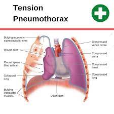 A doctor should be seen after any symptoms of chest pain are experienced, because of the possibility of other equally or more serious causes of chest pain. Can Cpr Cause A Pneumothorax Collapsed Lung Cpr Test