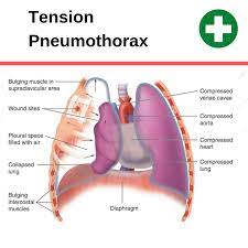 It occurs as a result of having an underlying lung disease, such as copd, cystic fibrosis, emphysema, asthma, tuberculosis, or whooping cough. Can Cpr Cause A Pneumothorax Collapsed Lung Cpr Test