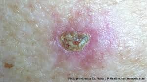 A new sore or raised area on an old scar or ulcer. Skin Cancer Pictures Photos Pictures Of Skin Cancer