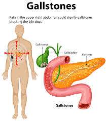 Image result for Gallstone