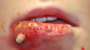 This strain of the common staph bacteria causes infections in different. Mrsa Staph Infection Pictures Symptoms Treatment And Prevention