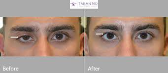 If you still don't see it, flip your. Eyelid Ptosis Droopy Eyelid Surgery Gallery Photos Mehryar Ray Taban Md