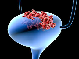 Two features that tend to mask the severity of the gross hematuria and may influence patients to postpone seeking immediate medical care are 1) the bleeding may be. Bladder Cancer Your Personal Risk And How To Reduce It Cleveland Clinic