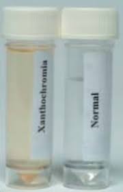 Image result for Cerebrospinal Fluid Color