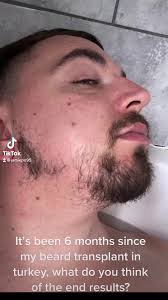 6-Month Hair Transplant Results: FlexEveryAngle Review