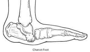 Charcot Foot Foot Health Facts