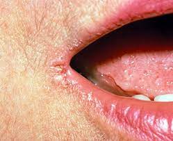 10 Best Home Remedies For Angular Cheilitis Cracked Corners Of Mouth Mouth Sores Fever Blister