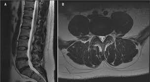 Image result for Low Back Imaging
