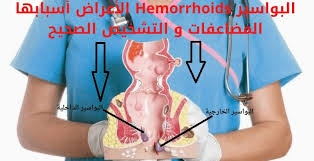 البواسير Hemorrhoids أنواعها الأعراض أسبابها المضاعفات و التشخيص الصحيح ثقفني