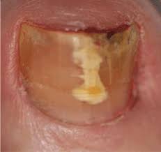 Image result for Beau lines feet