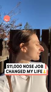 $11,000 Nose Job Changed My Life 😍