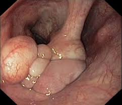 Imaging tests, such as computed tomography, magnetic resonance imaging, and positron emission tomography, are used to determine. Benign Laryngeal Tumors Ear Nose And Throat Disorders Merck Manuals Professional Edition