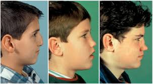 Definition, description, causes and risk factors: A 10 Year Old Boy With A Crooked Nose Due To Nasal Injury At The Age Download Scientific Diagram