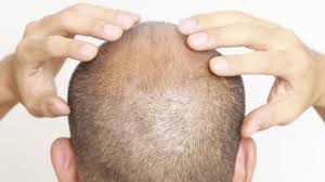 La coupe courte dégradée pour masquer une calvitie naissante. Les Coiffures Adaptees A La Perte De Cheveux